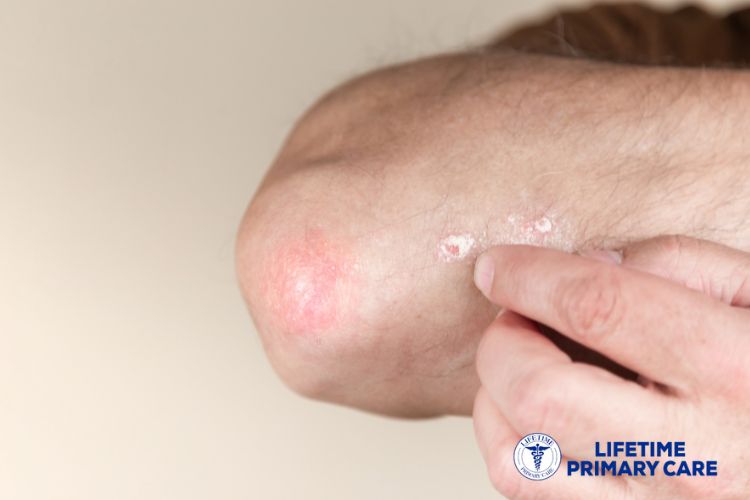 Managing Common Conditions like Acne, Eczema, Psoriasis, and Dermatitis