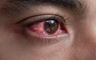 Constant Sneezing and Itchy Eyes: Causes, Relief, and When to Seek Help