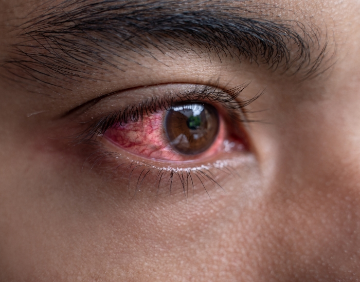 Constant Sneezing and Itchy Eyes: Causes, Relief, and When to Seek Help