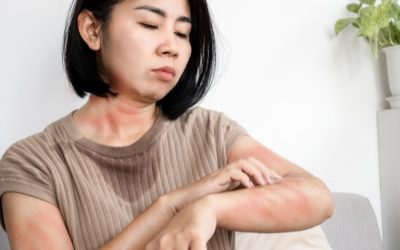 Skin Rashes and Swelling After Eating Certain Foods