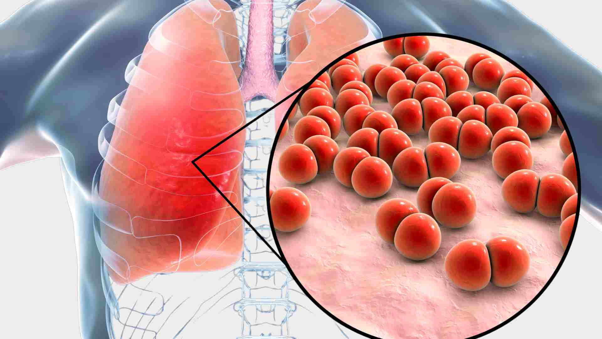 symptoms of pneumonia