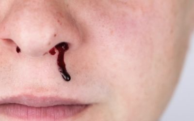 Frequent Nosebleeds and High Blood Pressure Symptoms: What You Need to Know